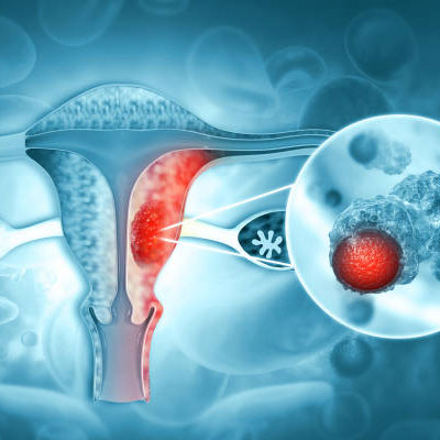 Cervical Cancer Treatment In Guntur