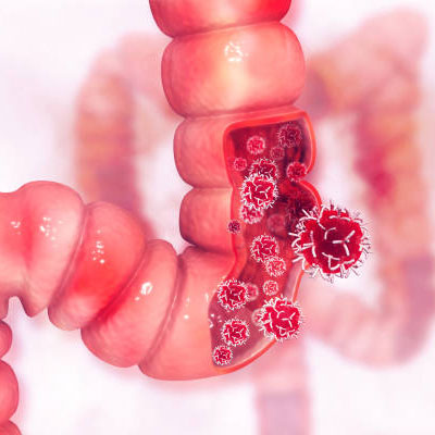 COLORECTAL CANCER