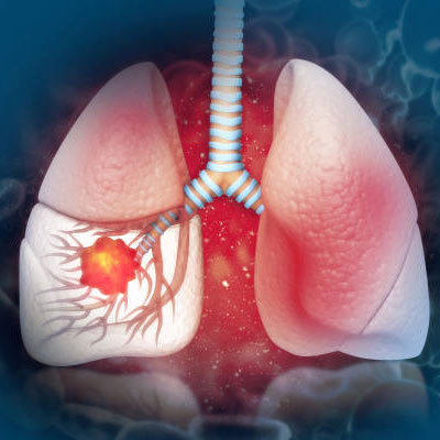 lung cancer treatment in Guntur