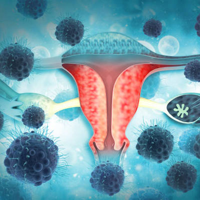 Ovarian Cancer Treatment In Guntur