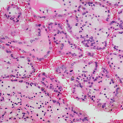 kidney cancer treatment in Guntur