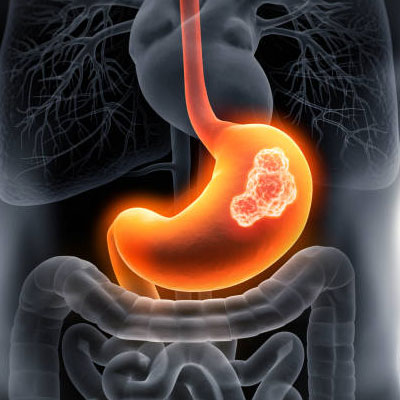 STOMACH CANCER