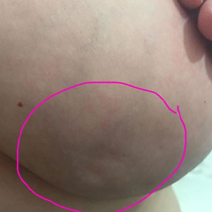 Dimpling of skin like the crest of an orange