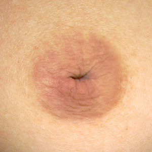Nipple that is inverted