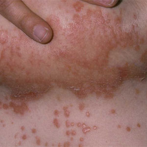 Redness of breast skin