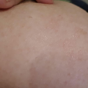Skin over the breast changes