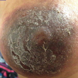 Peeling or scaling of the dark area around the nipple